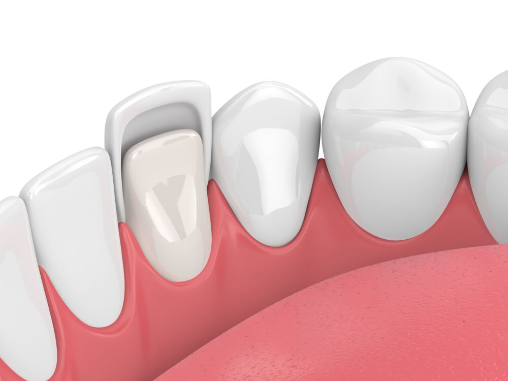 graphic of veneers being placed on teeth