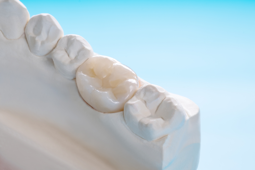 Prosthodontic of dental crown on mold